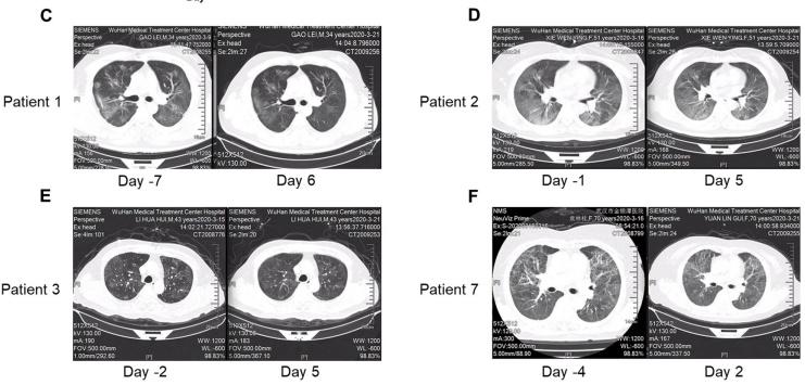 「新疆肺炎」〃新疆肺炎不排尿-第3张图片